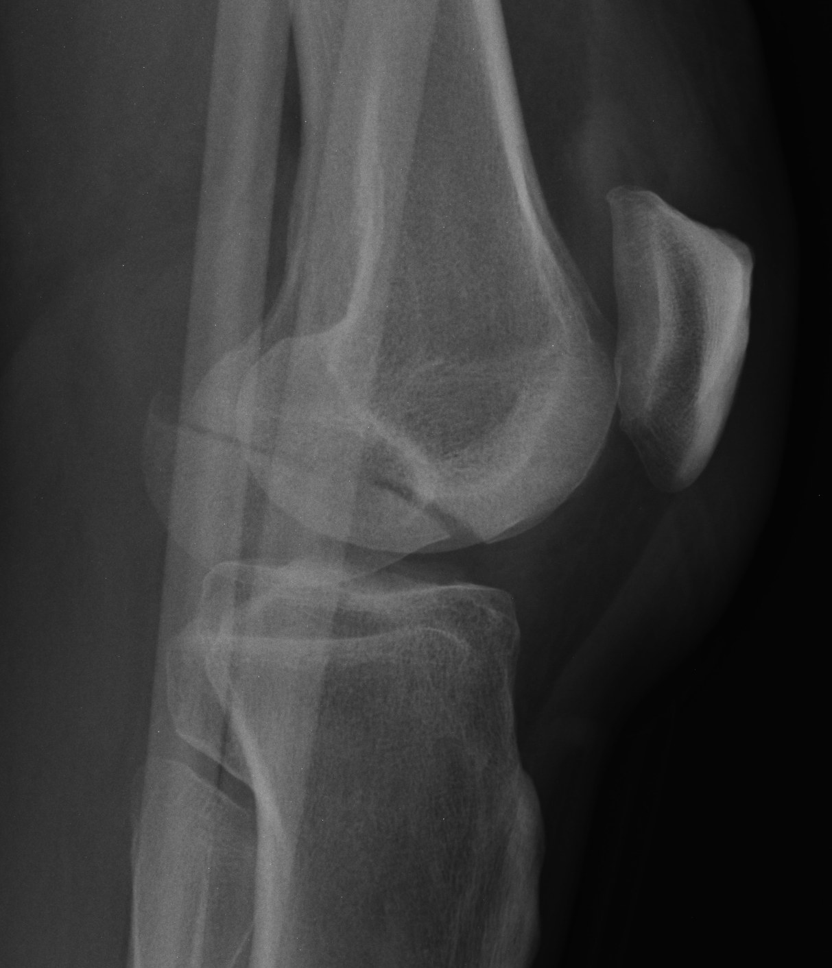 Hoffa Fracture Xray